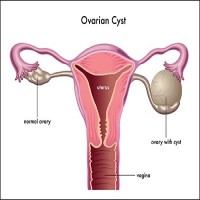 Ovarian Cysts treatment by Eva Hospital Ludhiana